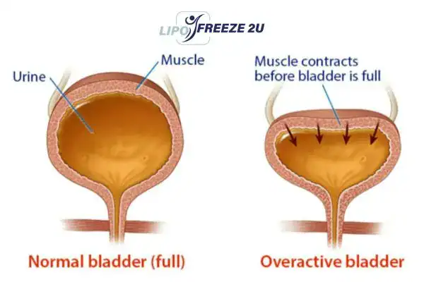 diagram of overactive bladder treatment Bere Regis