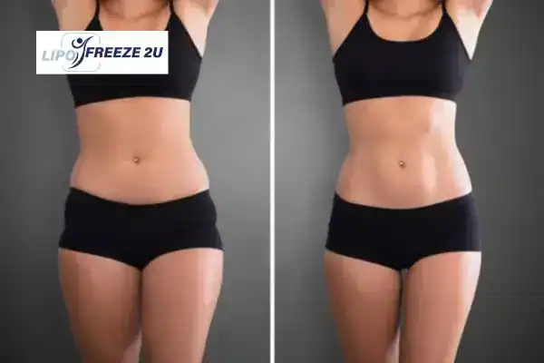 How Can LIPO FREEZE 2U Support Your Post-Pregnancy Body Recovery Bere Regis?