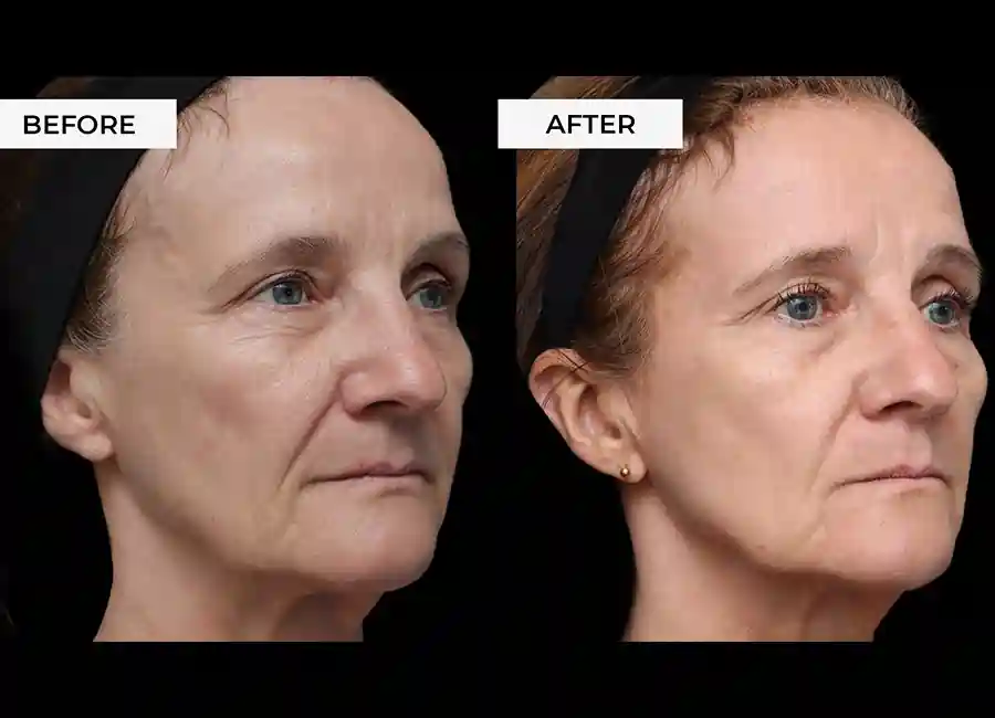 How Many RF Microneedling Sessions Will You Need to See a Difference Bere Regis?