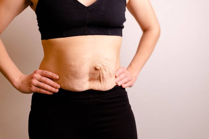 Is Surgery Really the Only Way to Repair Diastasis Recti Bere Regis?