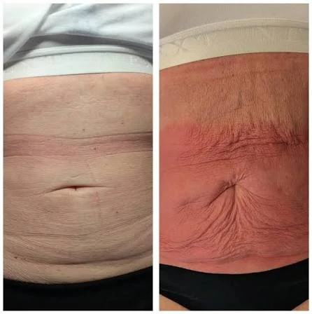 How Does RF Microneedling Improve Crepey, Thin and Uneven Skin Texture Bere Regis?