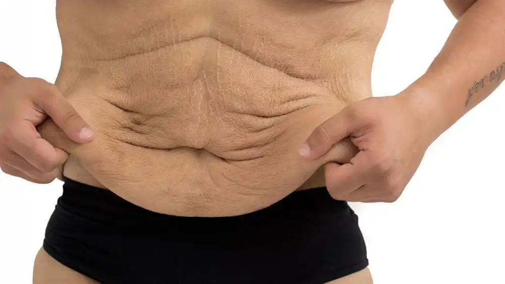 Why Does Weight Loss Medication Leave Some People With Loose or Sagging Skin Bere Regis?
